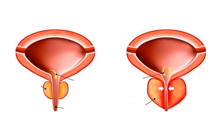 Normal an entzündegt Prostata