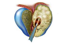 Manifestatioun vun akuter Prostatitis