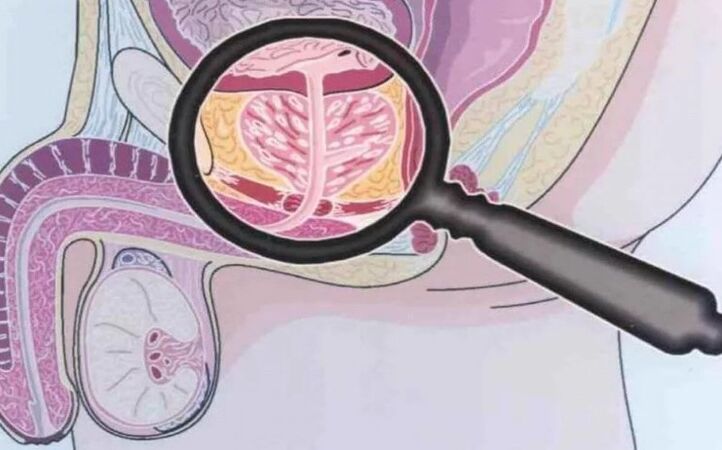 Chronesch Prostatitis