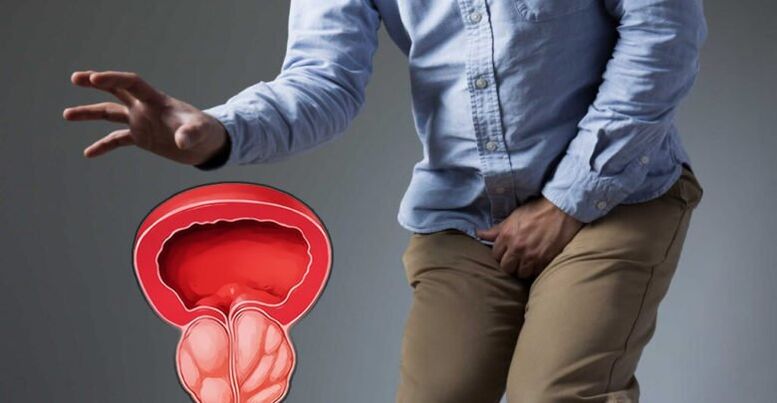 Präventioun vum Prostatitis a Prostata Adenom